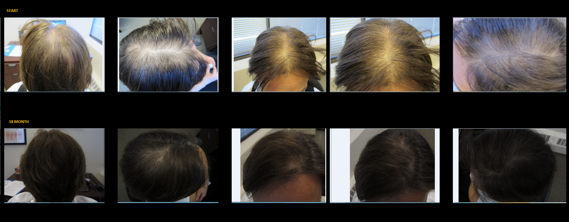 Laser Hair Restoration in Bristall, Leeds - The Cosmetic Room